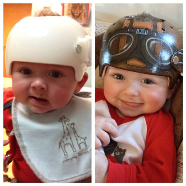 One Special Artist Paints Medical Helmets For Babies