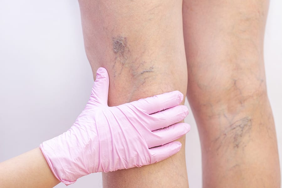 The Best Varicose Vein Treatments in Dallas, TX