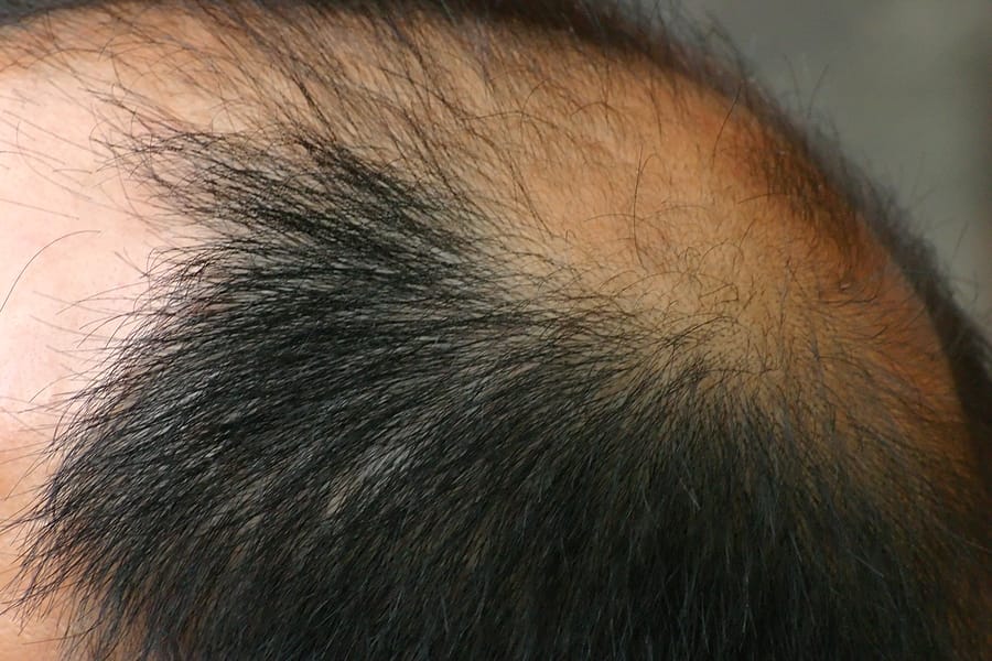 Male pattern hair loss - causes, symptoms and treatment 