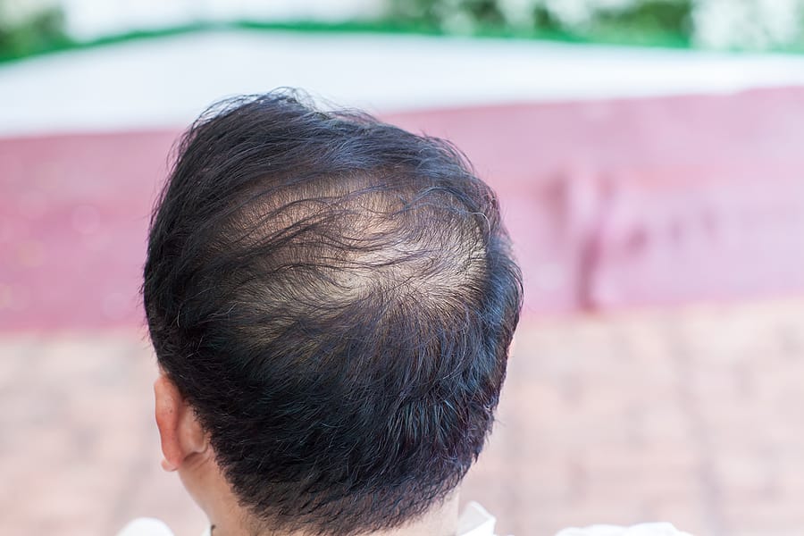 3 Common Causes of Hair Loss