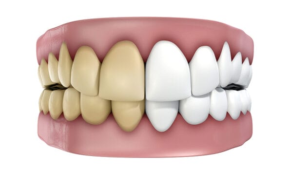 A set of false teeth with half clean and white and the other yellowed and stained on an isolated white studio background