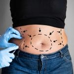  7 Reasons To Get The Liposuction For Reducing Body Fat
