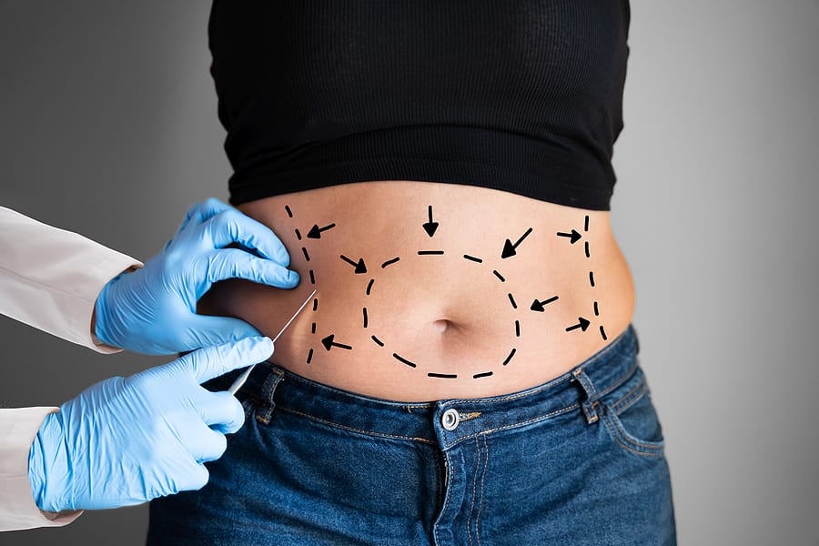  7 Reasons To Get The Liposuction For Reducing Body Fat