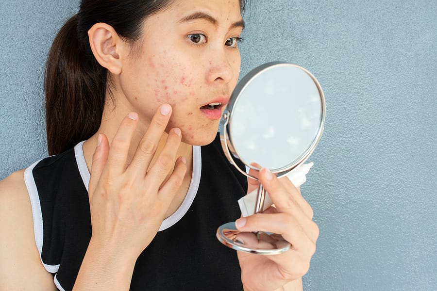 Top 3 Methods To Reduce Acne