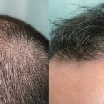 DHI Hair Transplant in Turkey: Things You Need to Know.