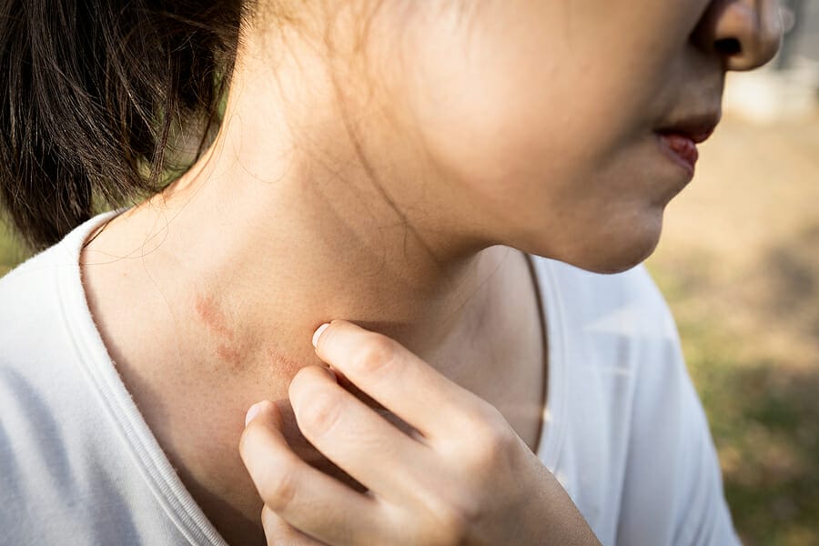 11 + Best Essential Oils for Itchy Skin | How to use & Safety