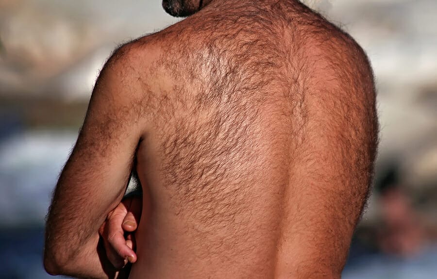 Say Goodbye to Back Hair: How Laser Hair Removal Can Help Men